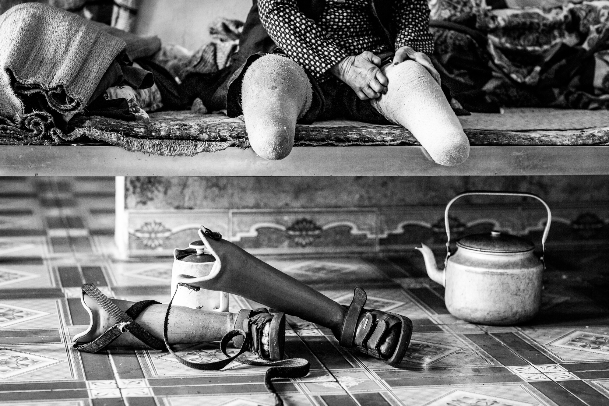 A woman prepares to attached her artificial legs lost to leprosy in a colony in northern Vietnam