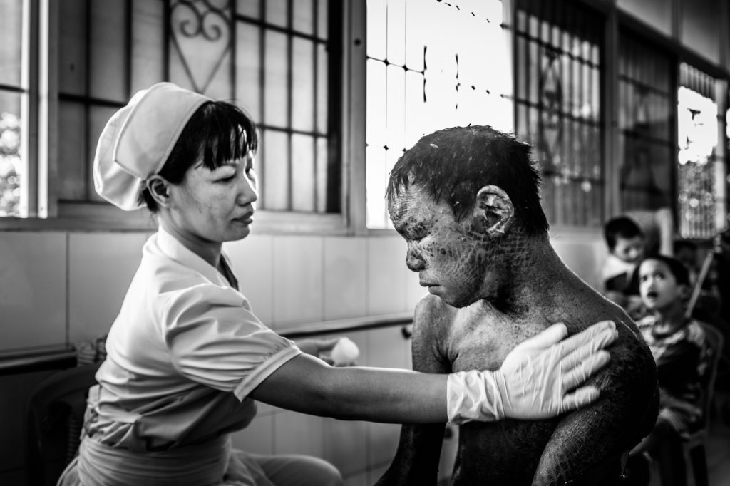 A boy suffering from a skin disease receives care from a nurse